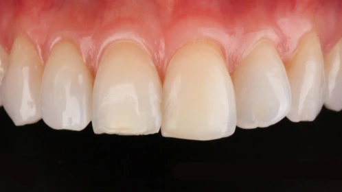 Traitement par laser